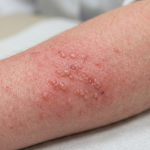 Zöliakie und Haut – Dermatitis herpetiformis Hautreaktion auf Gluten